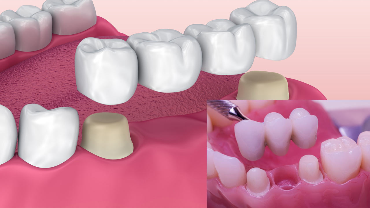 Dental Bridges Dental Health