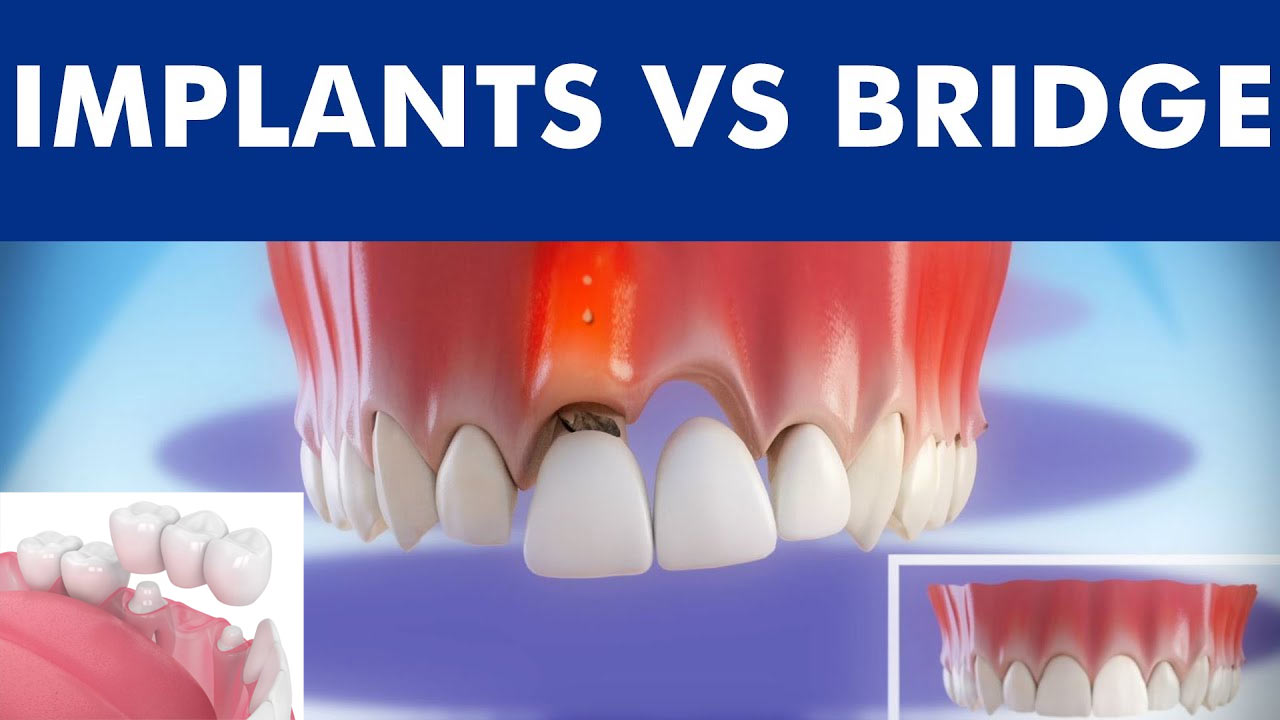 The Pros And Cons Of Dental Bridges Vs Crowns Dental Health