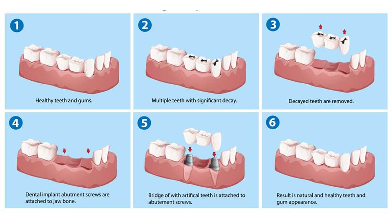 Dental Bridge Costs With And Without Insurance Dental Health