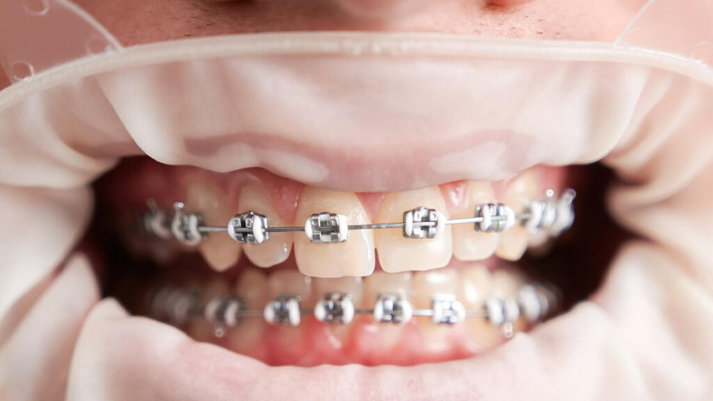 The Different Types of Braces and Orthodontic Treatment