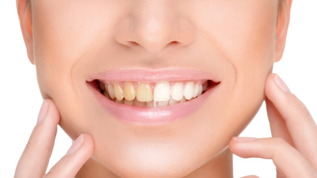 The Risks and Benefits of Teeth Whitening