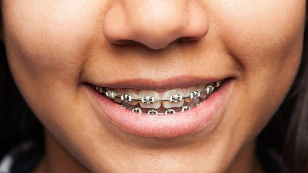 The Different Types of Braces and Orthodontic Treatment