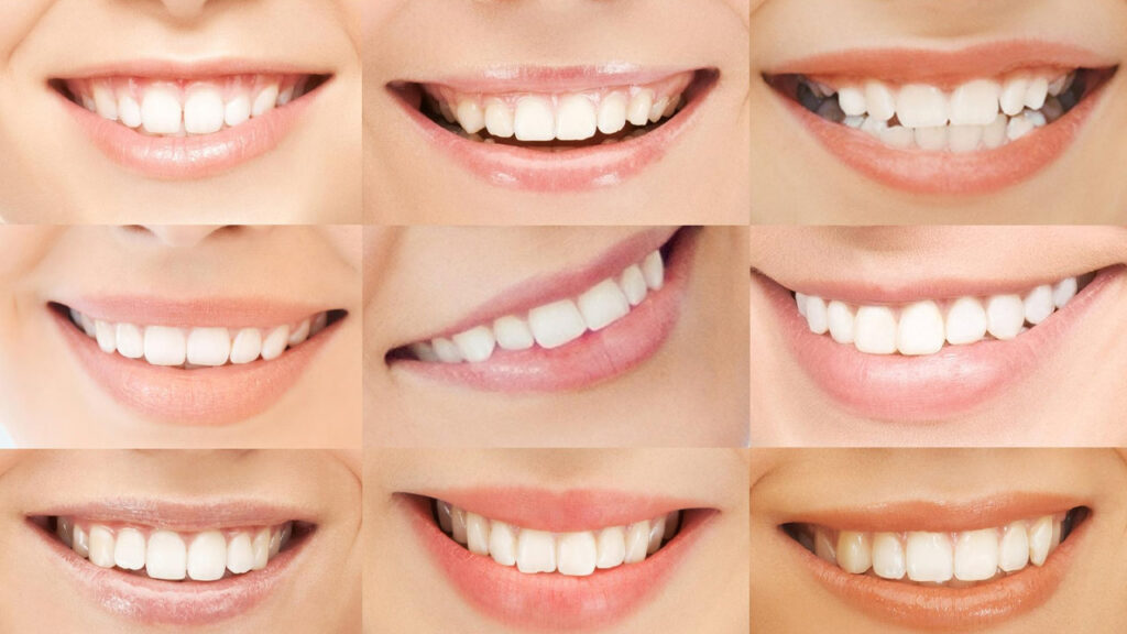 The Risks and Benefits of Teeth Whitening