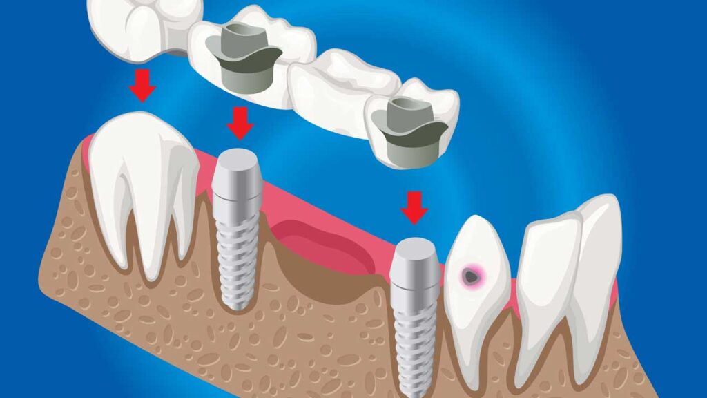 Caring for Dental Bridges and Crowns