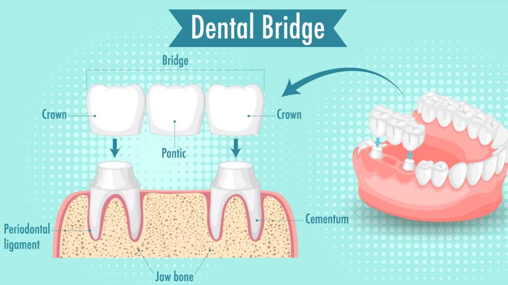 Caring for Dental Bridges and Crowns