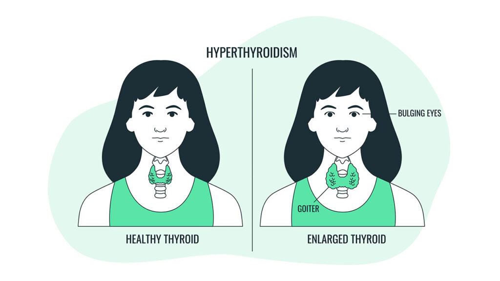 The Connection Between Dental Health and Thyroid Disease