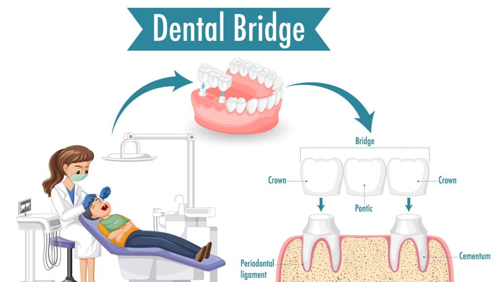 The Pros and Cons of Dental Bridges vs Veneers