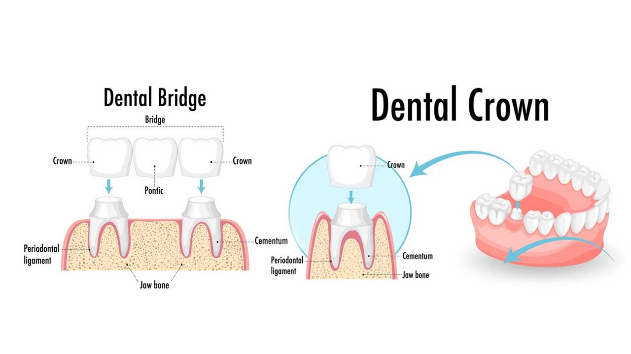 The Pros and Cons of Dental Bridges vs Crowns