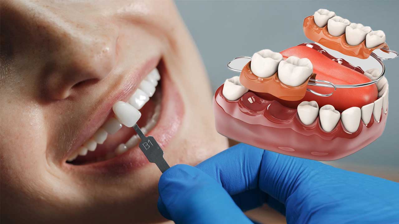 The Pros and Cons of Dental Bridges vs Veneers