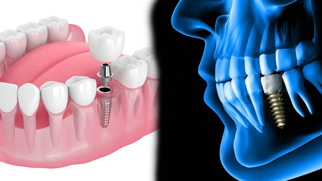 The Risks and Benefits of Dental Implants vs Dentures