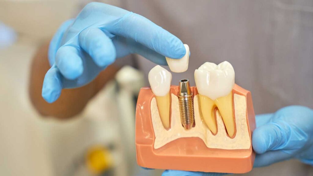 Dental Implants What You Need to Know
