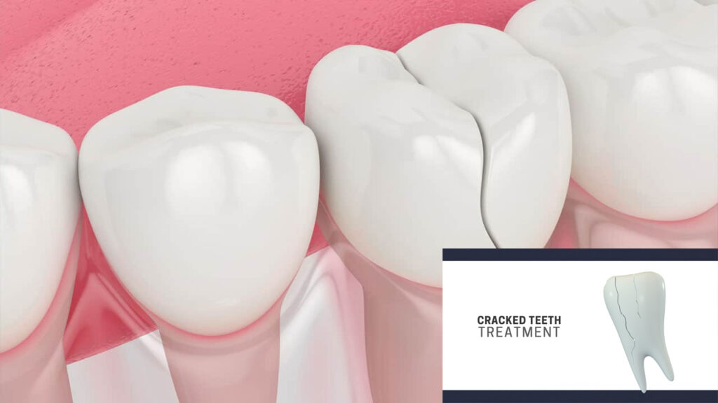 The Different Types of Dental Trauma and How to Address Fractures