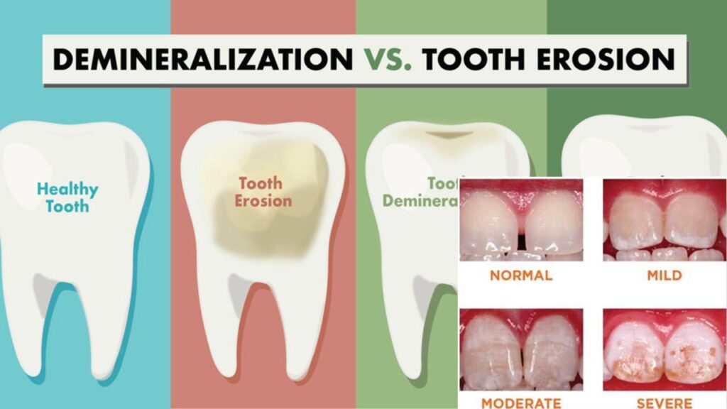 How do you know your enamel is gone?