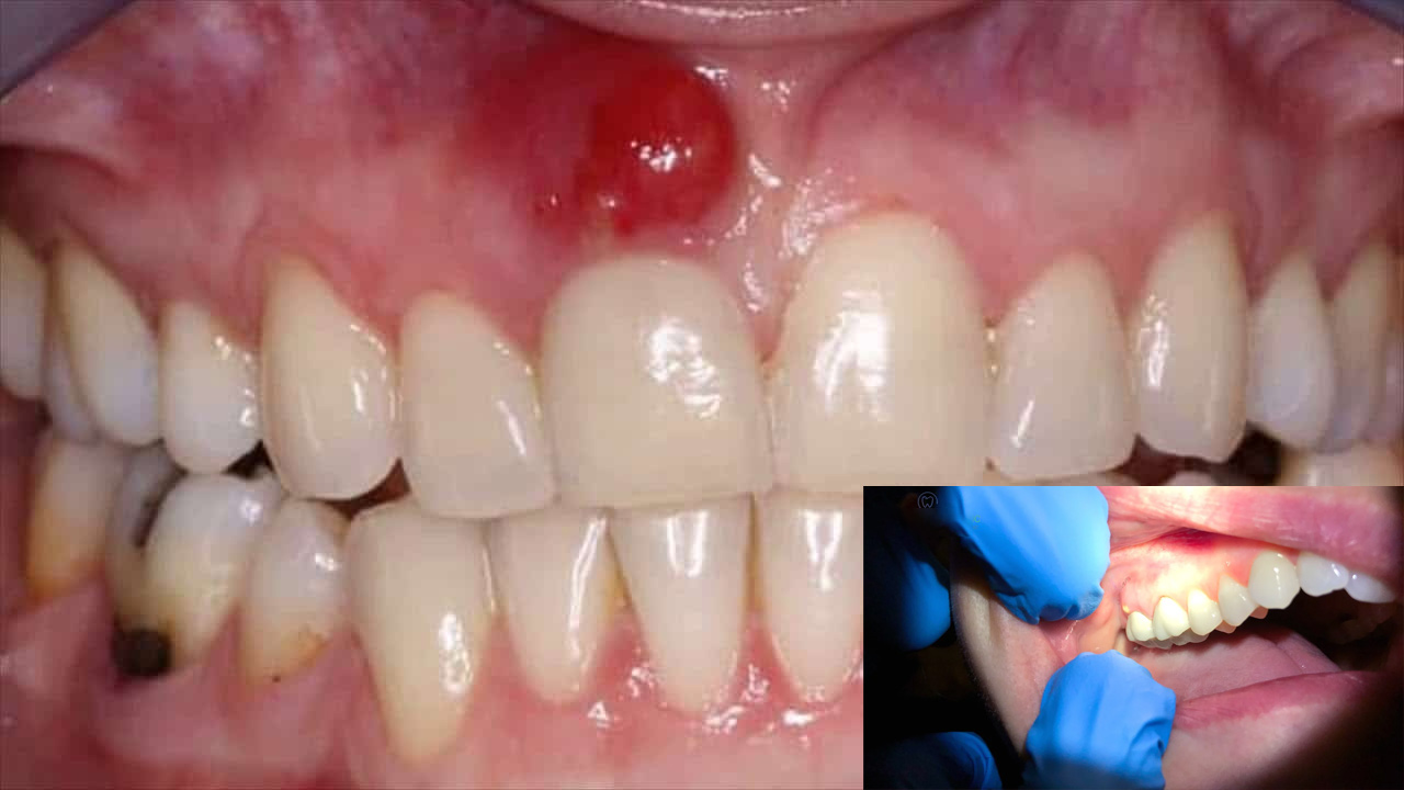 The Role of Dental Hygiene in Preventing Oral Infections