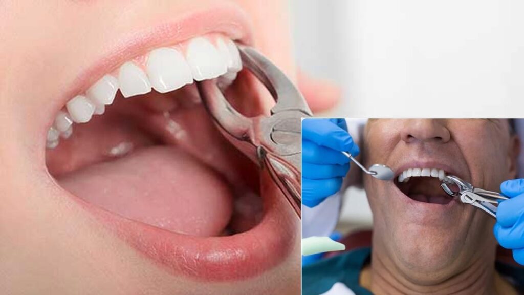 The Different Types of Dental Extractions Explained