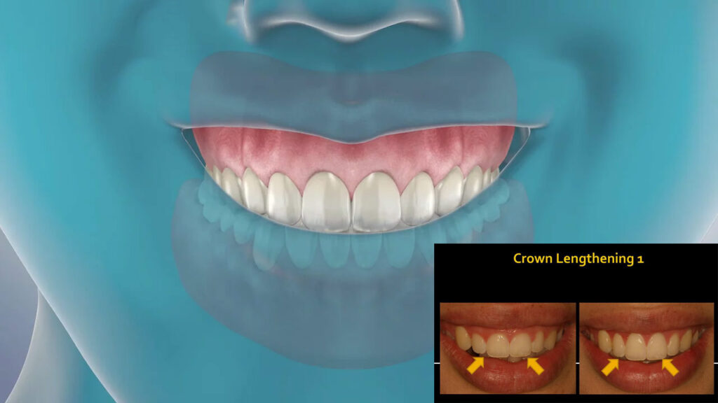 The Pros and Cons of Dental Crown Lengthening