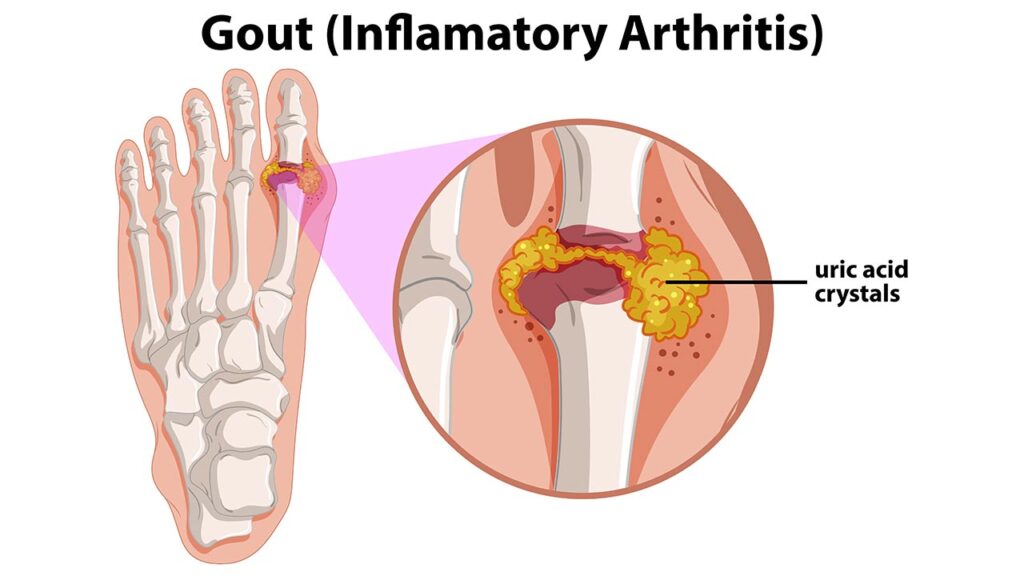 The Importance of Dental Care for People with Rheumatoid Arthritis