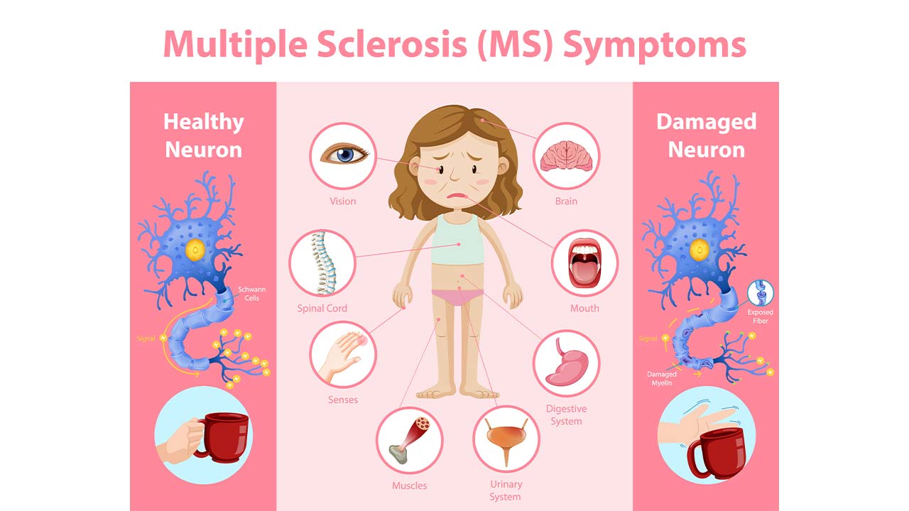 The Importance of Dental Care for People with Multiple Sclerosis ...