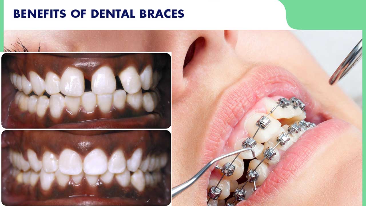 The Benefits of Dental Orthotics Dental Health