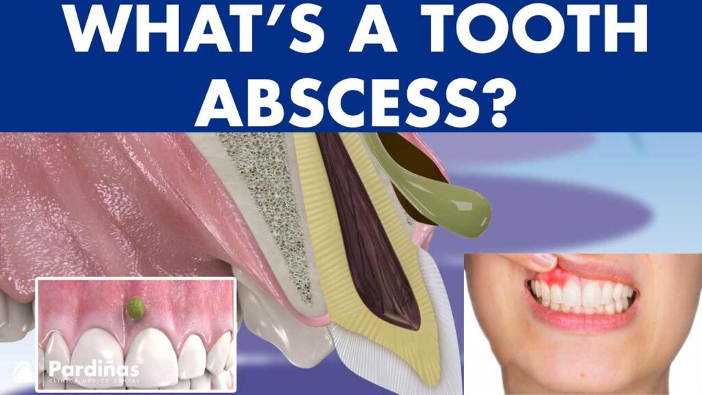 The Different Types of Dental Abscesses and How to Treat Them