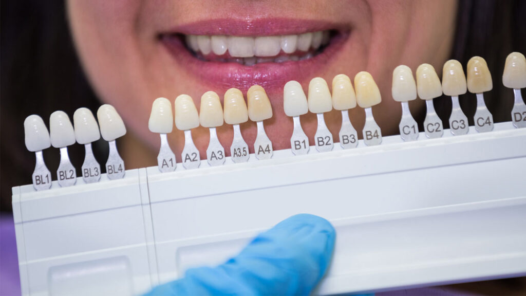 The Different Types of Dental Crowns Explained