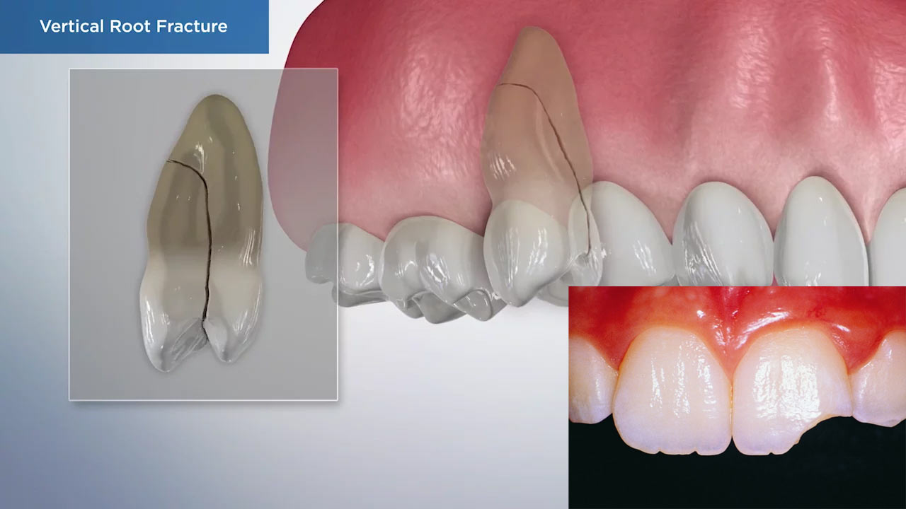 The Different Types of Dental Trauma and How to Address Fractures