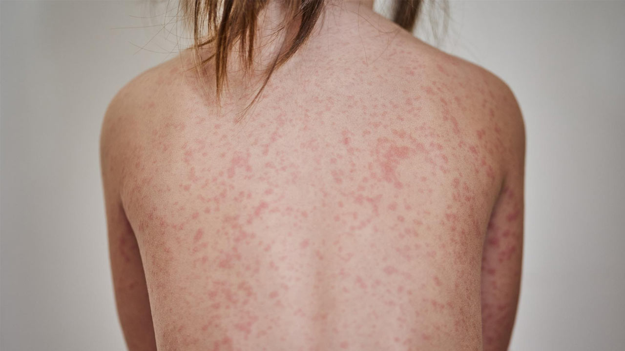 The Importance of Dental Care for People with Eczema