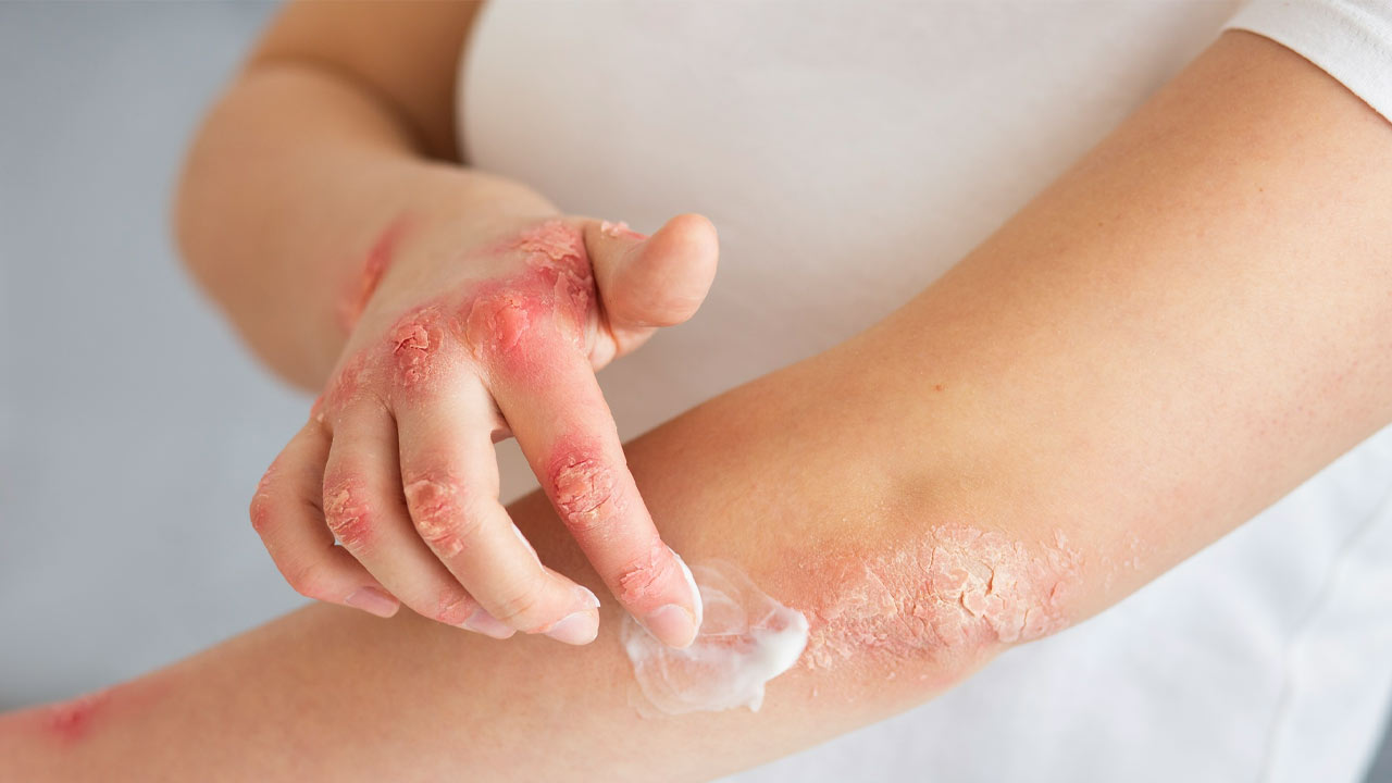 The Importance of Dental Care for People with Lupus