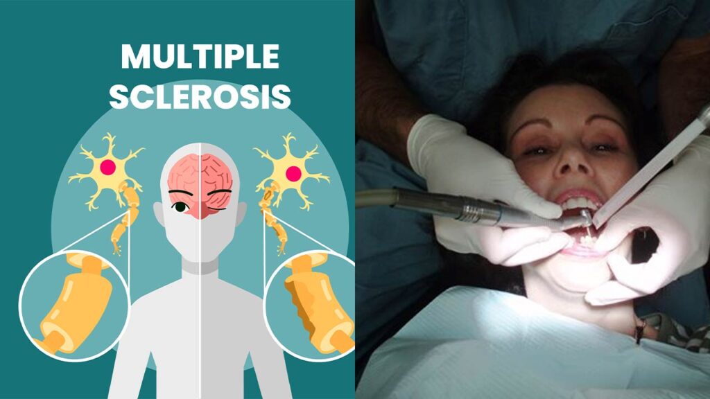 The Importance of Dental Care for People with Multiple Sclerosis