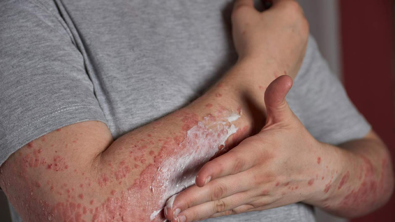 The Importance of Dental Care for People with Psoriasis