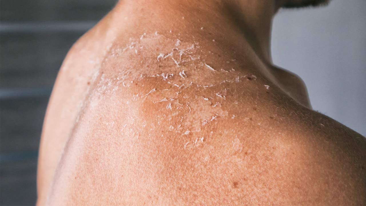 The Importance of Dental Care for People with Scleroderma