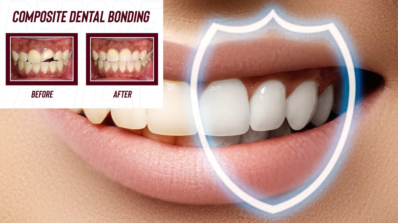 The Pros And Cons Of Dental Bonding Dental Health 5961