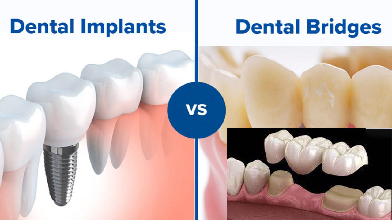 Dental Bridges - Dental Health