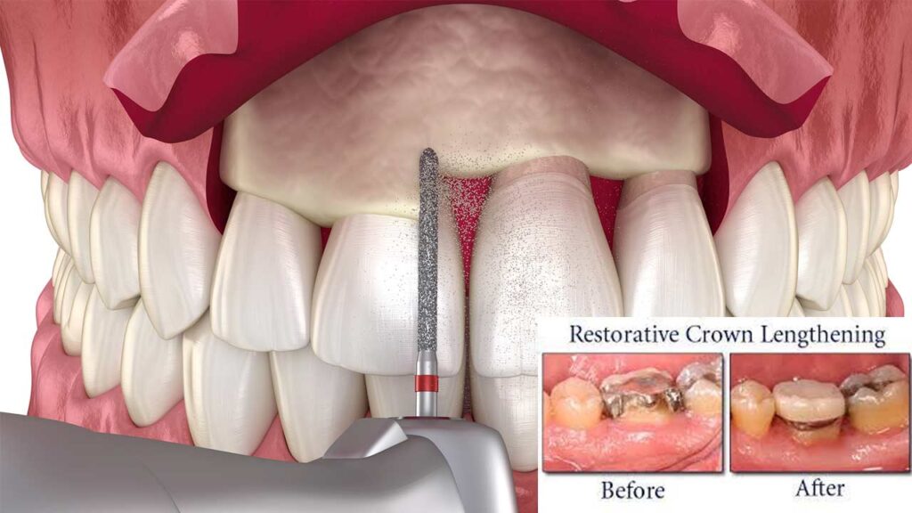 The Pros and Cons of Dental Crown Lengthening