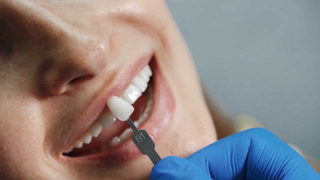 The Pros and Cons of Dental Veneers