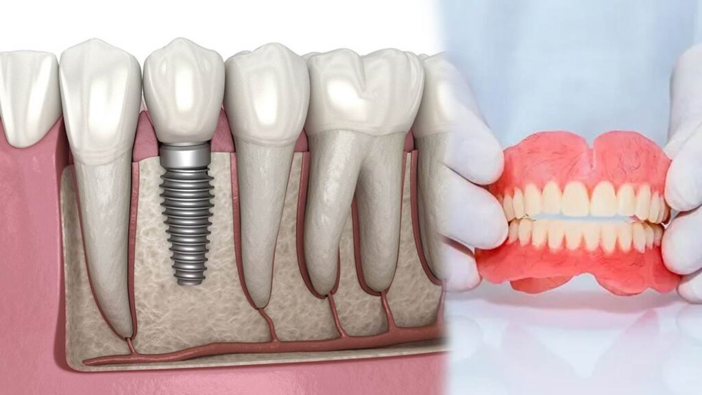 The Risks and Benefits of Dental Implants vs Dentures