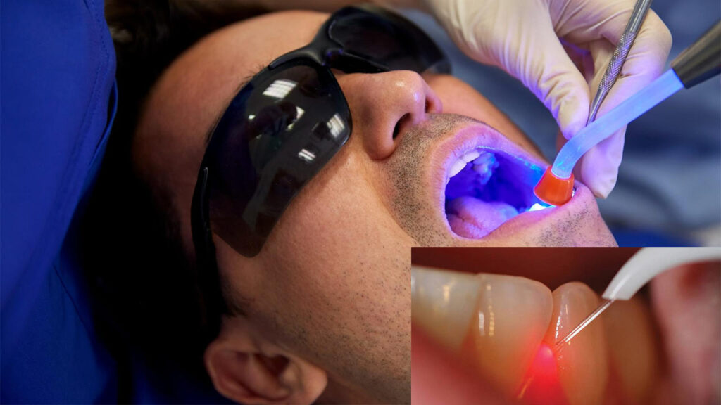 The Risks and Benefits of Dental Laser Treatment