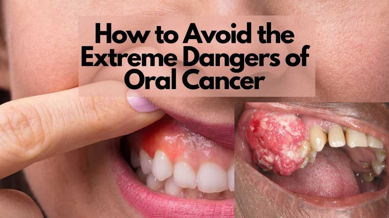 the-role-of-dental-hygiene-in-preventing-oral-cancer-dental-health