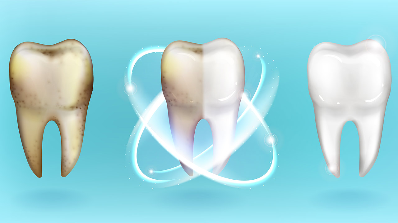 The Role of Dental Hygiene in Preventing Tooth Discoloration