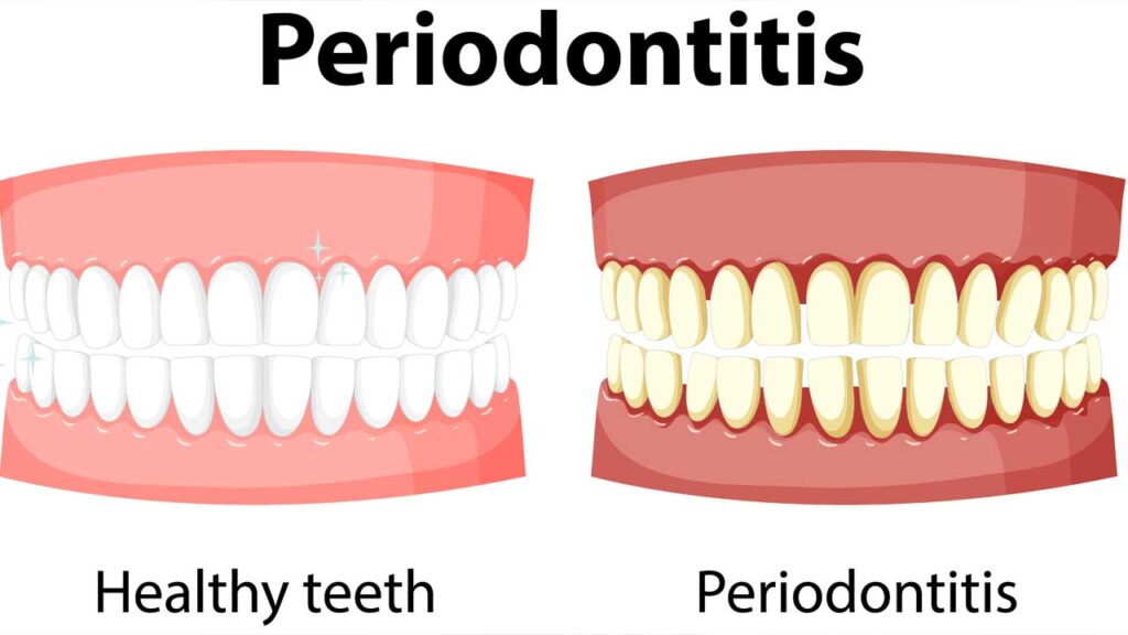 The Role of Diet in Preventing and Treating Periodontal Disease