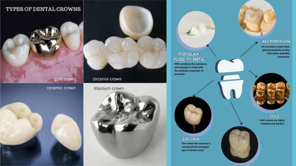 The Different Types of Dental Crowns Explained