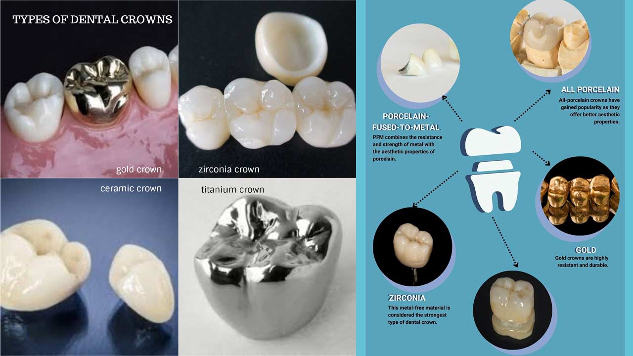 The Different Types of Dental Crowns Explained Dental Health