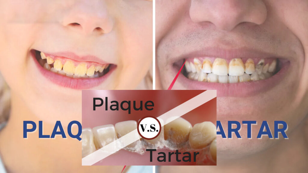 Understanding Dental Plaque and Tartar