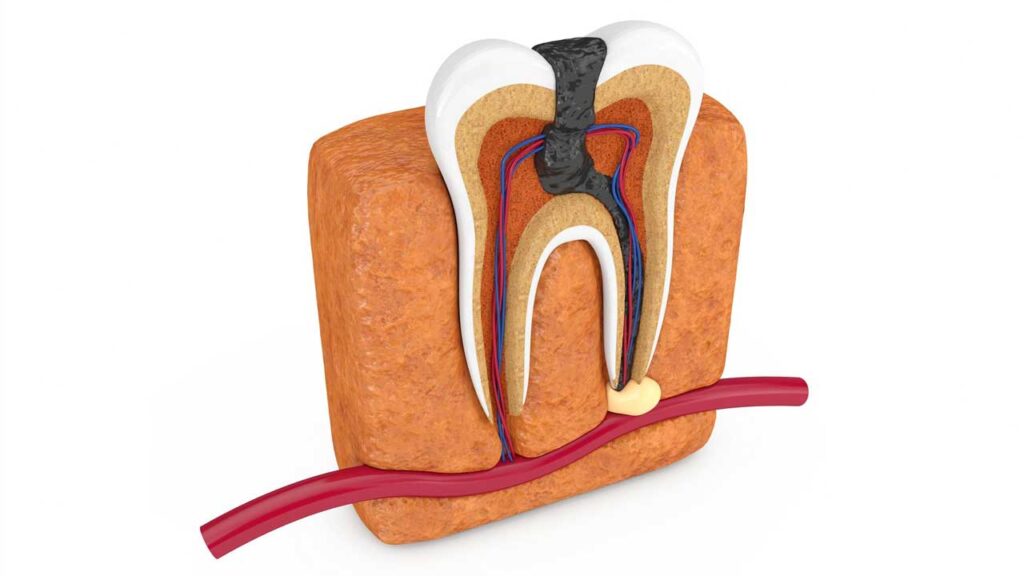 Understanding Root Canals and Endodontic Treatment