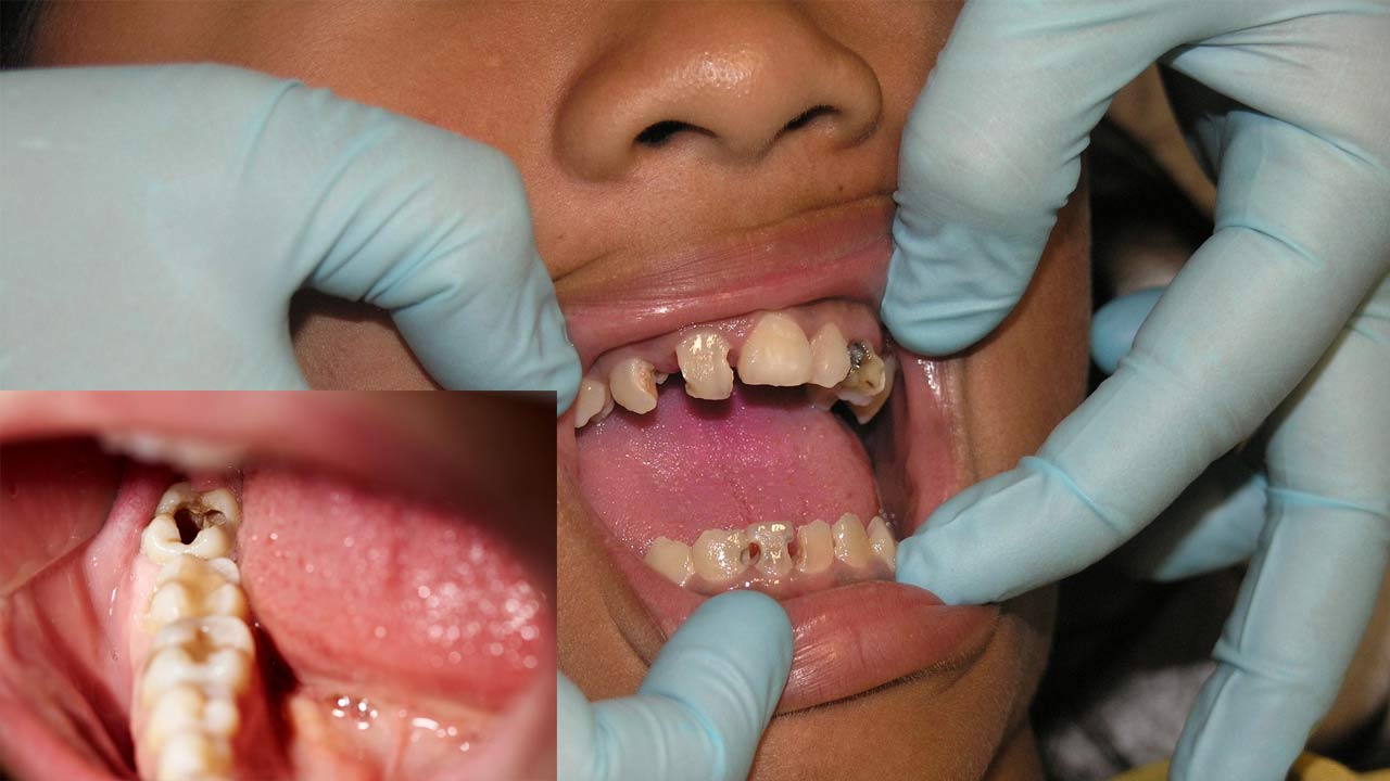 What causes the most damage to teeth?