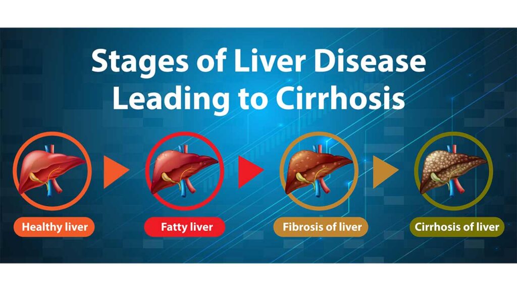 The Connection Between Dental Health and Liver Disease