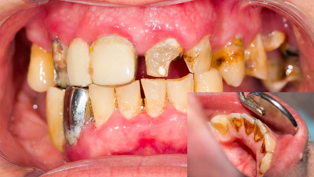 What is Poor Oral Hygiene?