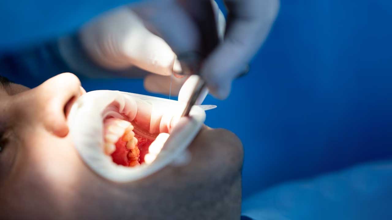 What are Gum Stimulators and Why are They Important for Oral Health