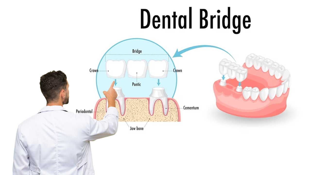 Dental Bridge Costs: With and Without Insurance