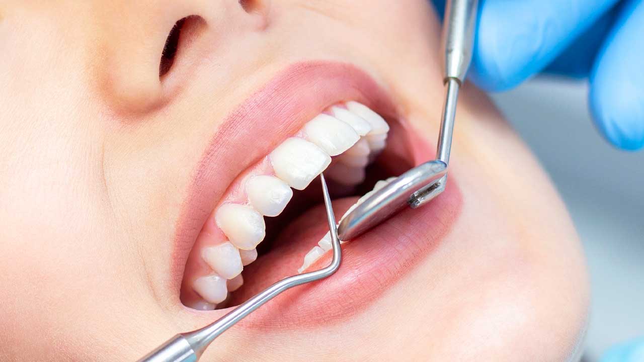 Everything You Need to Know About Dental Cleaning Process.